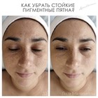 Как убрать стойкие Пигментные Пятна, не поддающиеся обычным методам? Как убрать стойкие Пигментные Пятна, не поддающиеся обычным методам?