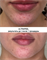 ULTRAPEEL | пилинг УЛЬТРА  против акне и розацеа SKINCOUTURE | до после