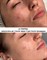 ULTRAPEEL | пилинг УЛЬТРА  против акне и розацеа SKINCOUTURE | до после